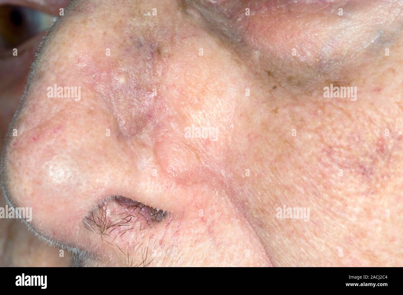 Cancer De La Peau Sur Le Nez Photo Close-up de la cicatrice sur le nez à une patiente de 82 ans après  l'excision (ablation chirurgicale) d'un carcinome baso-cellulaire (cancer  de la peau). Aussi connu Photo Stock - Alamy