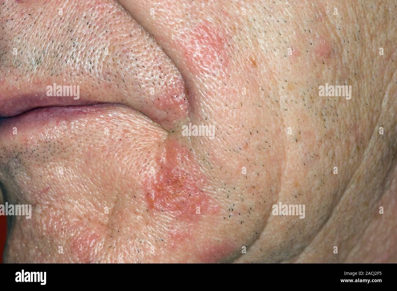 Close-up of a zona éruption sur la face dans un patient de sexe masculin de 77 ans. Le zona est une éruption de peau provoquée par le virus varicelle-zona (herpès) qui att Banque D'Images