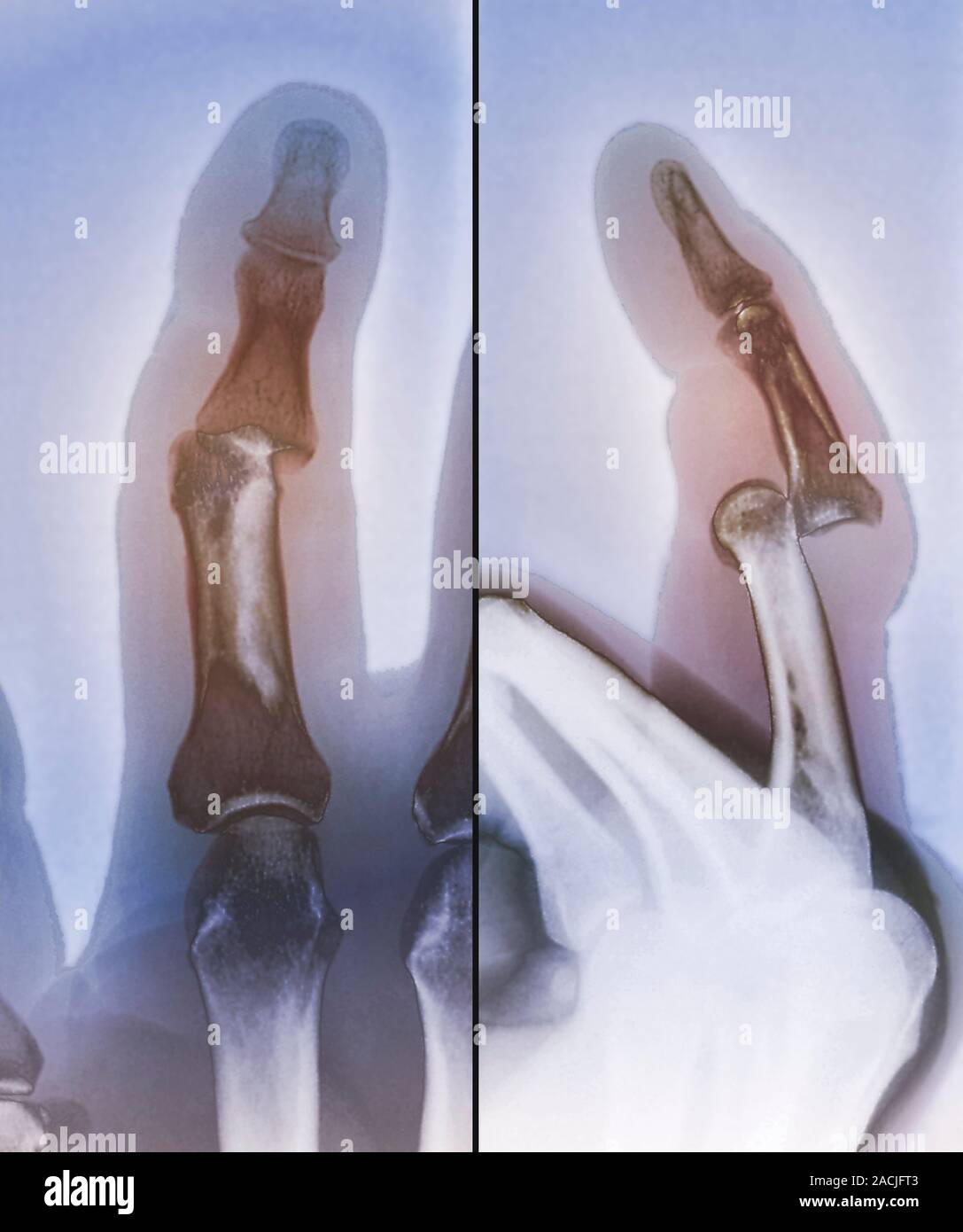 X-ray de couleur (deux fois) de la dislocation de la subluxation () d'une articulation interphalangienne (panels) après une blessure. Banque D'Images