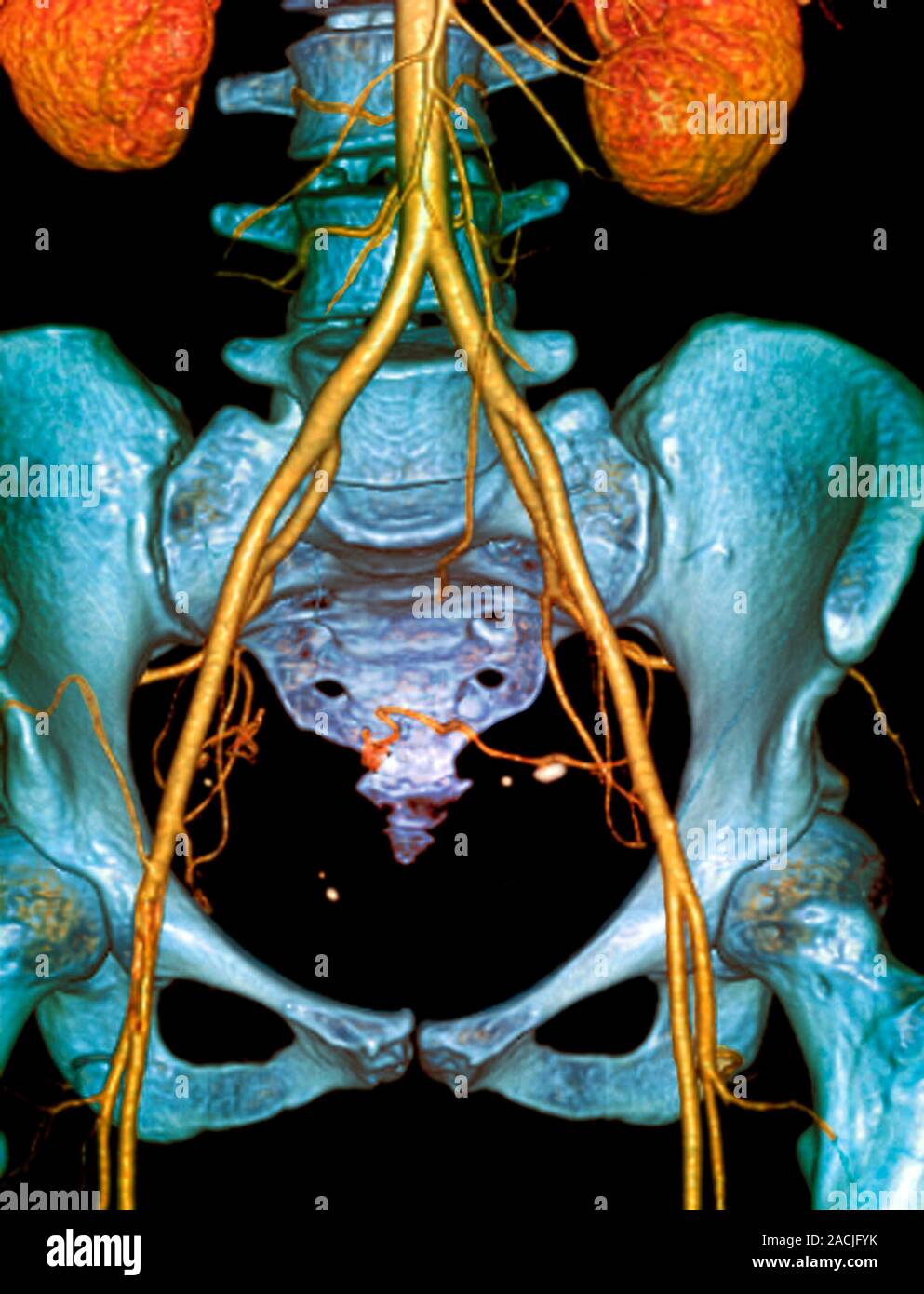 Trois couleur dimensions (3d) la tomodensitométrie (TDM) coronarographie  scanner en vue avant d'artères abdominales sain (jaune) dans un patient de  34 ans Photo Stock - Alamy