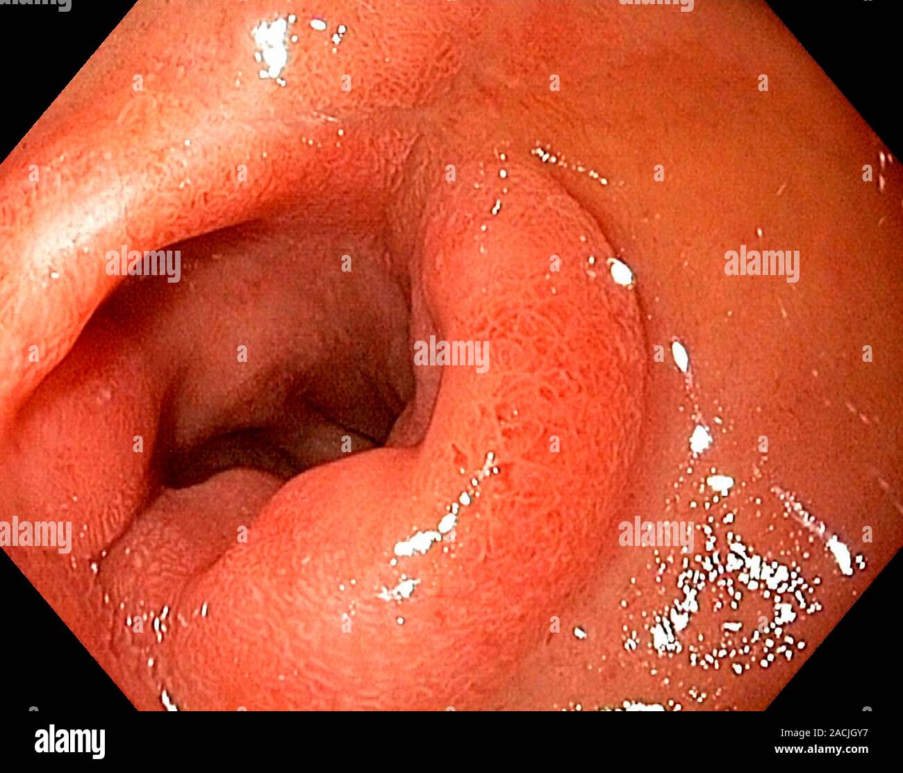 Prijs Onderdompeling dump Voir l'endoscope de la paroi du duodénum, le début de l'intestin grêle,  montrant un relief dans le bulbe duodénal causé par un ulcère Photo Stock -  Alamy