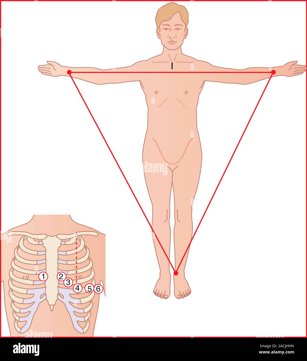 Placement des électrodes ECG. L'oeuvre de l'ordinateur montrant l