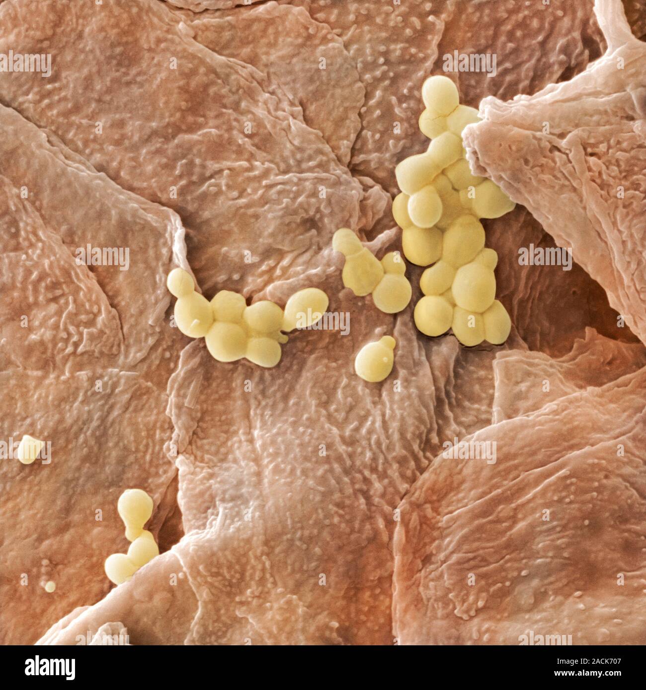 Champignon levure infections cutanées. Couleur de l'analyse des électrons Microphotographie (SEM) de la peau humaine infectée par un champignon de levure. Agrandissement : x3130 lors de l'impression Banque D'Images