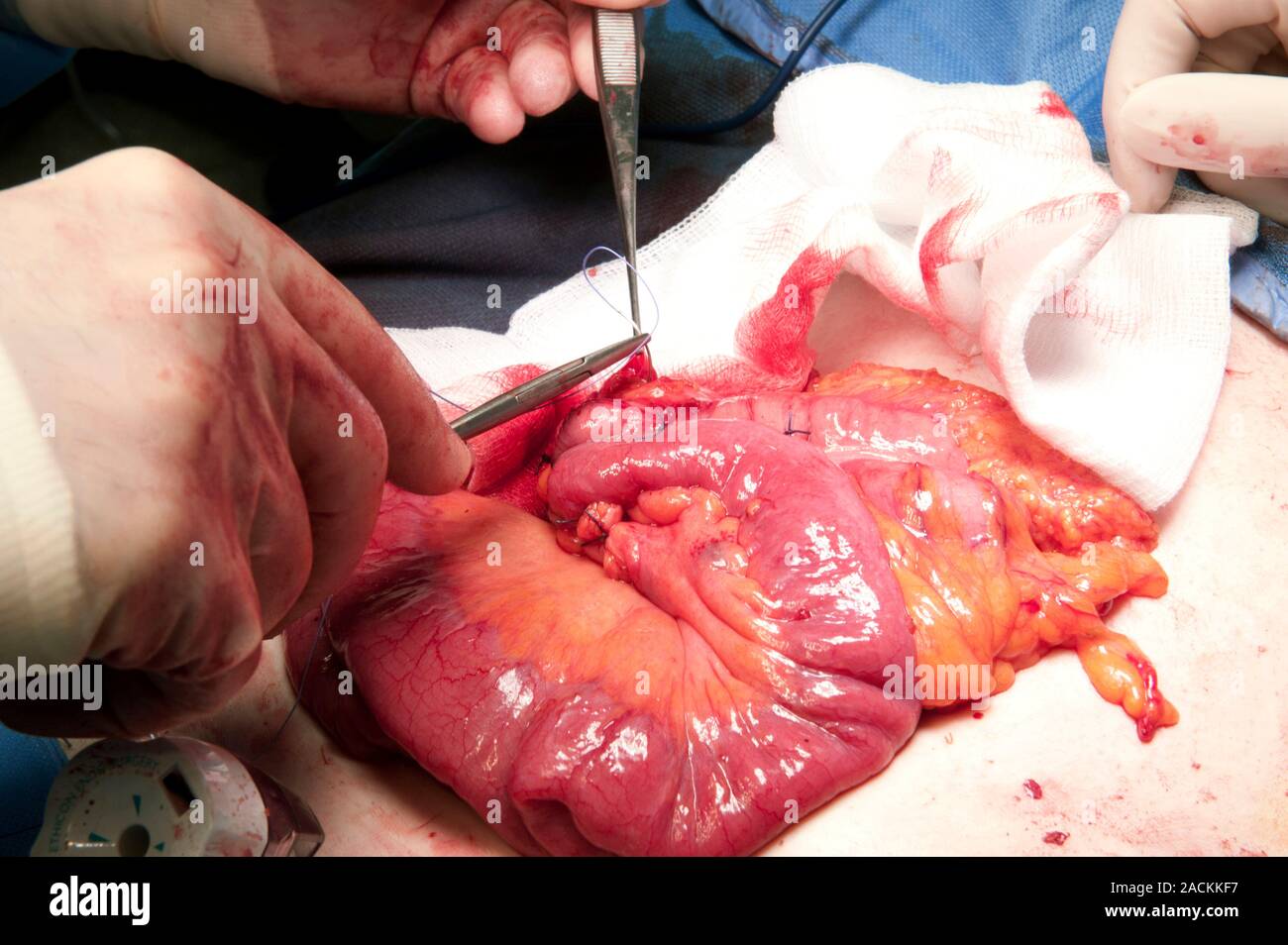Chirurgiens les mains gantées dans une salle d'opération Retirer le côlon  sigmoïde (gros intestin) à une patiente âgée de 70 ans avec un cancer de l' intestin (carcinomes Photo Stock - Alamy