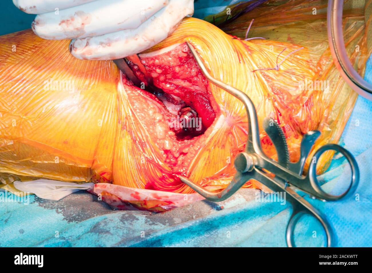 Luxation de la hanche congénitale la chirurgie. Un chirurgien opérant sur 15-month-old girl avec luxation congénitale de la hanche (CDH). CDH provoque l'articulation de la hanche à Banque D'Images