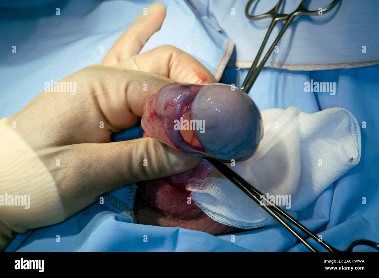 La chirurgie de déplacement de kyste de l'épididyme. Chirurgien opérant