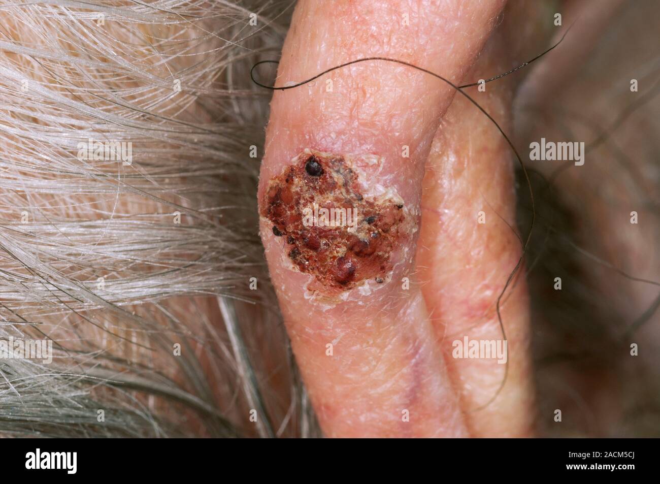 Close-up du carcinome basocellulaire (CBC), ou ulcus rodens, sur l'oreille  d'un patient âgé de 91 ans. C'est la forme la plus courante de cancer de la  peau causé Photo Stock - Alamy