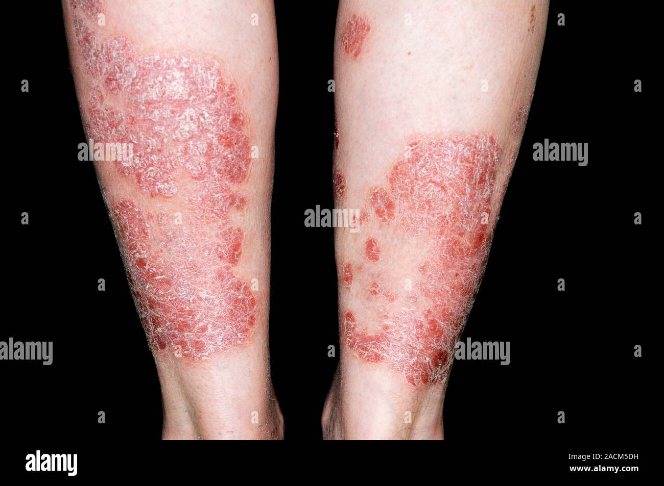 Le psoriasis en plaques sur la peau des jambes dans un homme de 55 ans, une  affection de la peau du patient dans lequel la croissance excessive des  cellules de la peau