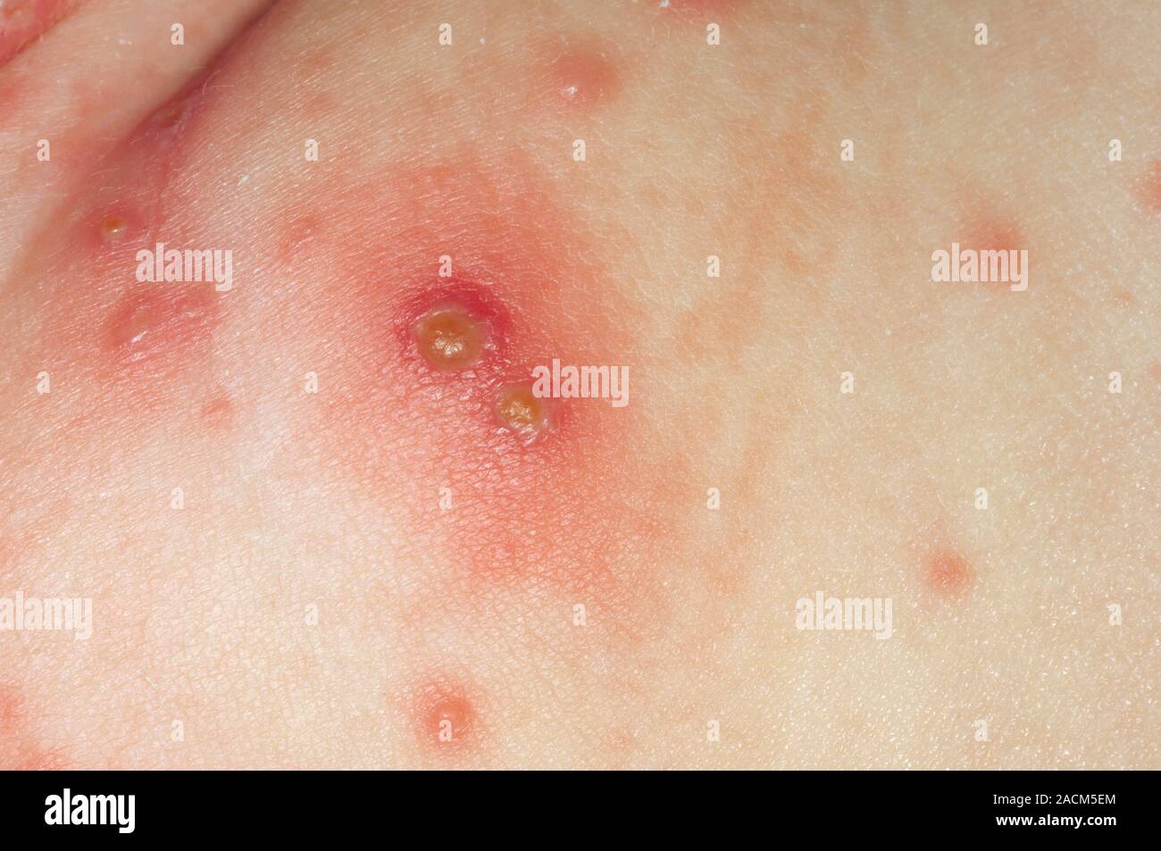 L'éruption de la varicelle (varicelle) taches sur les fesses dans ...