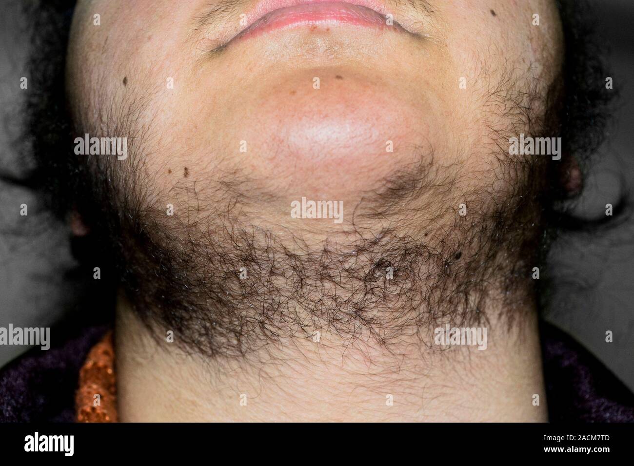 L'hirsutisme (pilosité excessive) sur le visage d'une patiente ...
