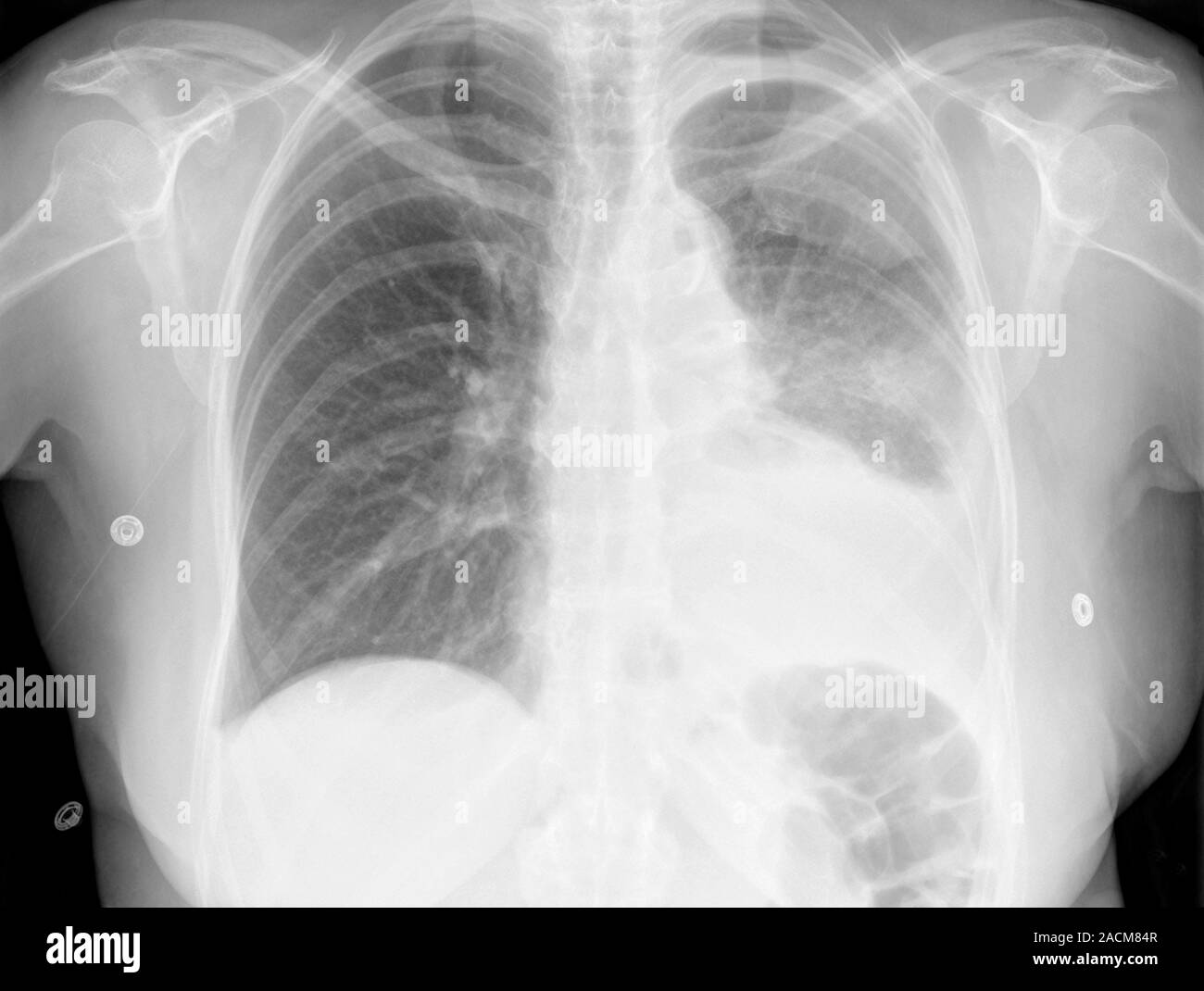 Radiographie montrant l'épanchement pleural (accumulation de liquide ...