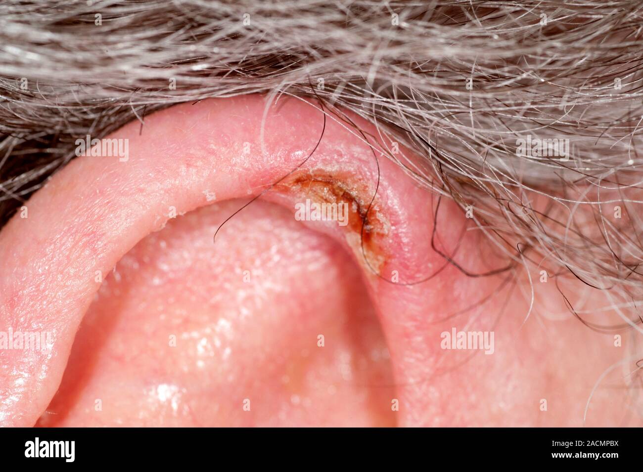Close-up d'un nodule rouge et mutilée sur le pavillon de l'oreille dans un  patient de sexe masculin de 67 ans, connu sous le nom de chondrodermatitis  nodularis helicis (CNH). C'est un benig