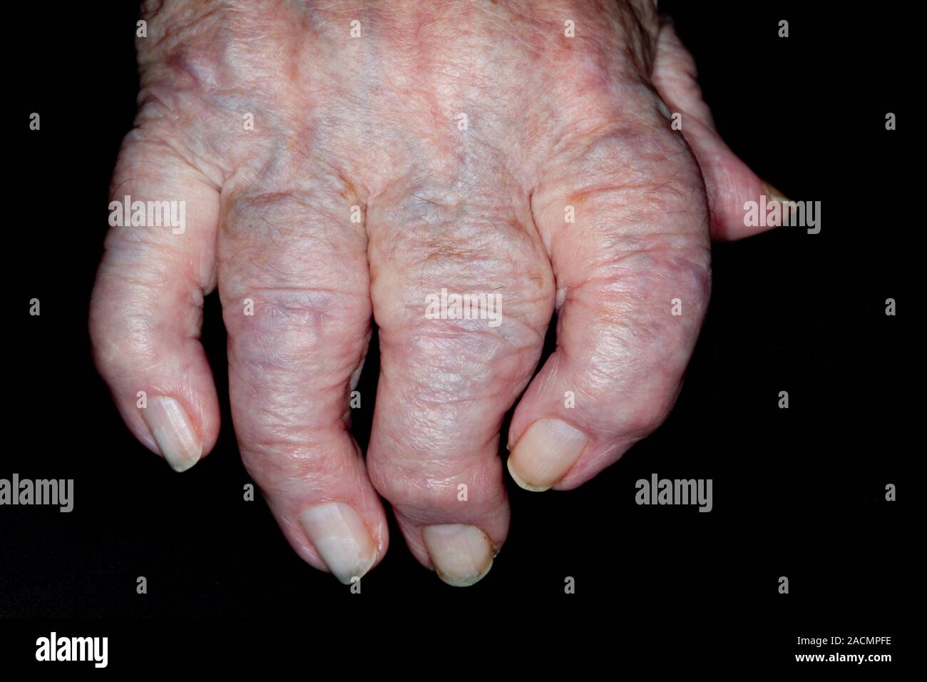 Gonflé et déformé la main et des doigts dans une patiente de 96 ...