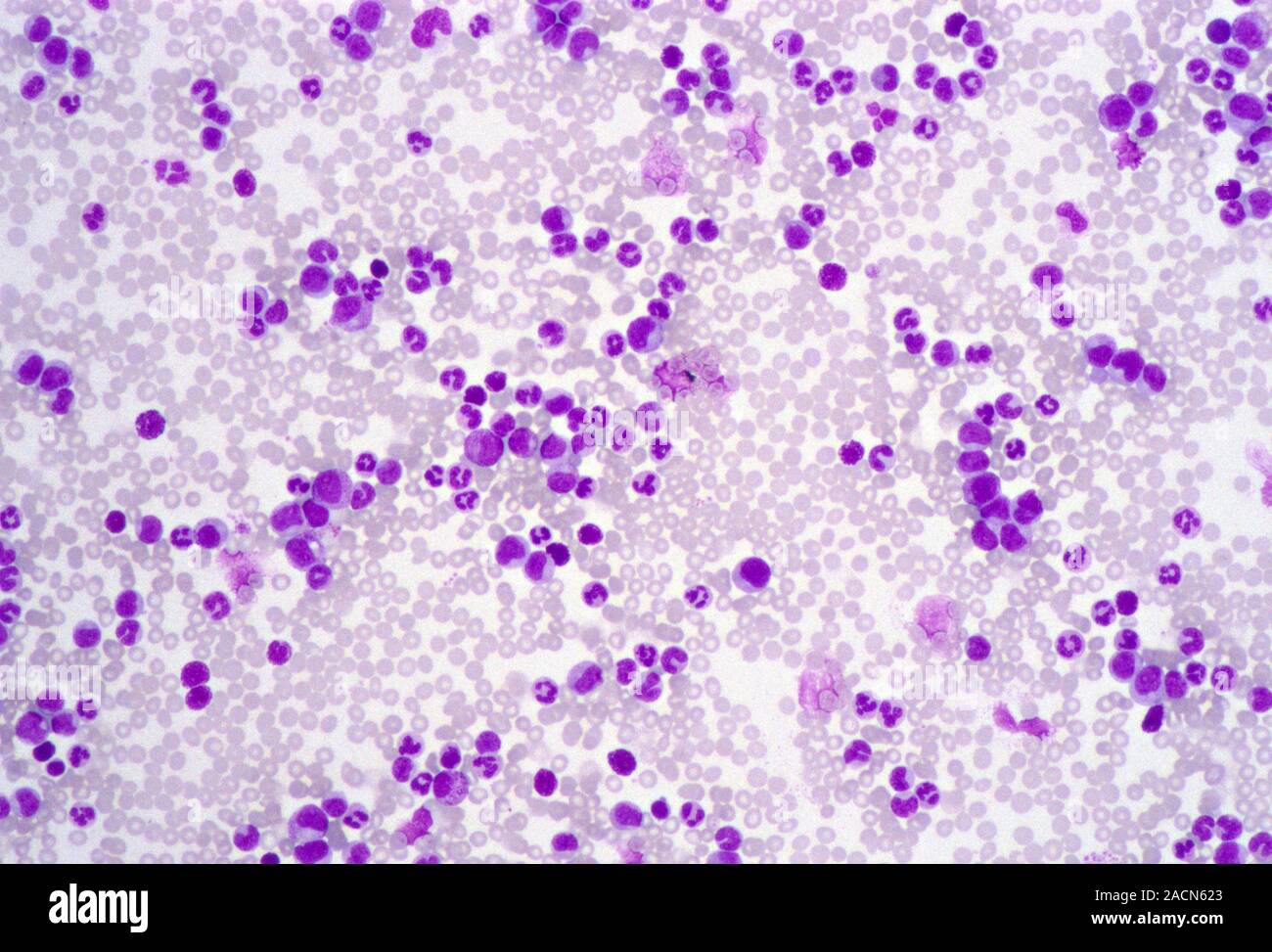 La leucémie myéloïde aiguë. Micrograph Light d'un frottis sanguin d'un  patient atteint de leucémie aiguë myéloïde (LAM). Ce cancer affecte le tissu  myéloïde Photo Stock - Alamy