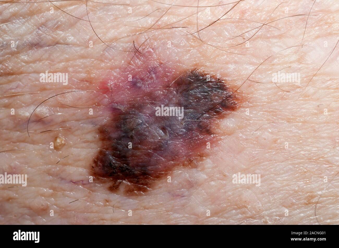 Close-up de cancer de la peau, un mélanome de l'épandage superficiel (SSM) sur la cuisse dans un patient de sexe masculin âgé de 84 ans, montrant son évolution nodulaire et propagation. Banque D'Images