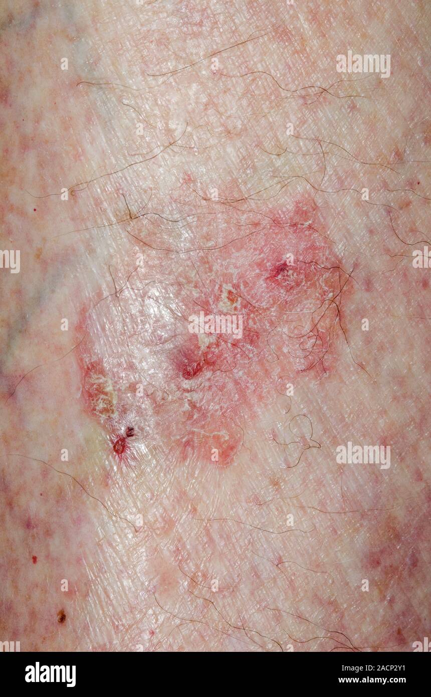 Close-up d'une lésion de la peau sur le tibia de la jambe lors d ...