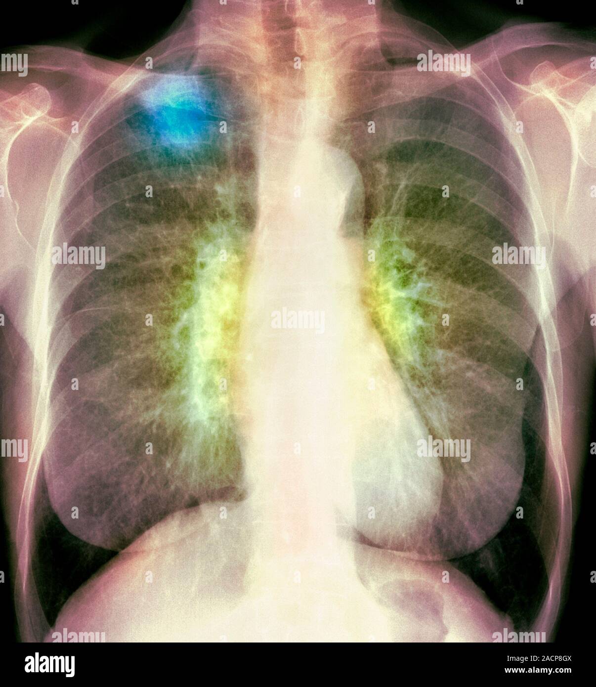 Le cancer du poumon. Xray de couleur de la poitrine d'une femme de 84 — free download
