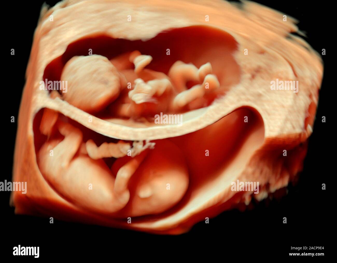 Semaine 12 foetus jumeaux, 3D échographie. Trois dimensions (3D — free download