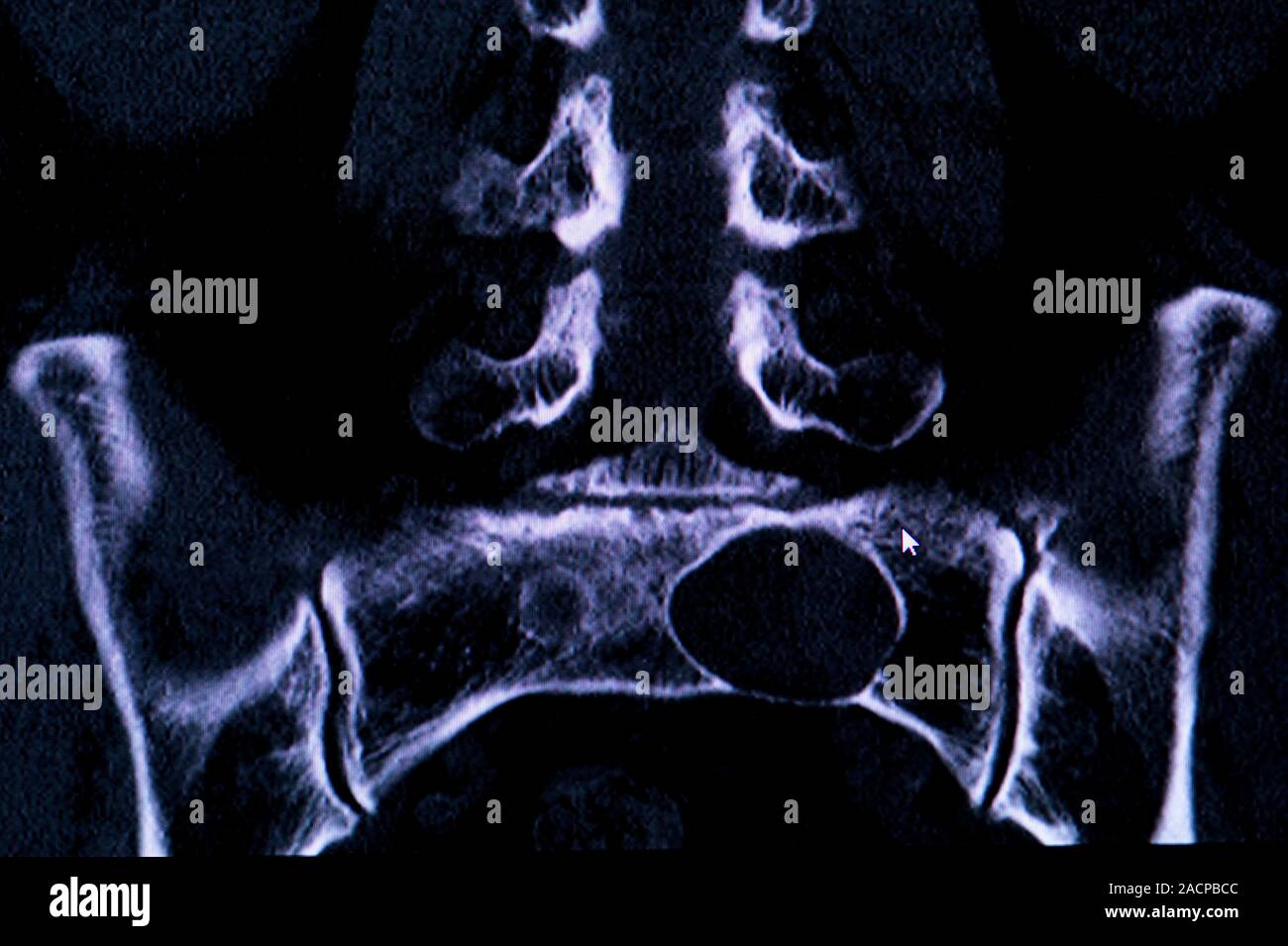 Tarlov kyste de la colonne vertébrale. L