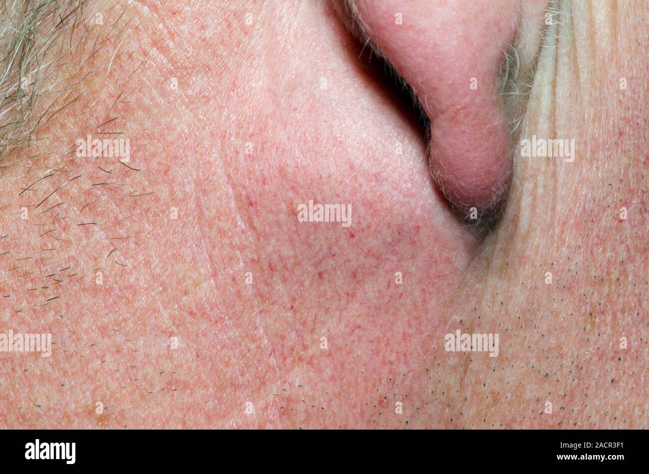 Kyste sébacé derrière l'oreille d'un patient de sexe masculin de 46 ans. Ce  kyste formé lorsque la glande sébacée (sécrétion) associé à un follicule de  cheveux bec Photo Stock - Alamy