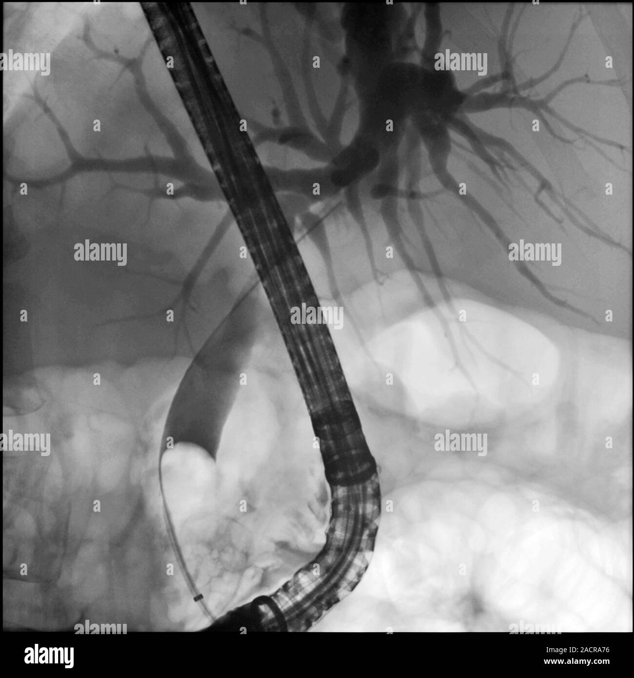 Les calculs rénaux. Xray du rein d'un patient avec des pierres de rein