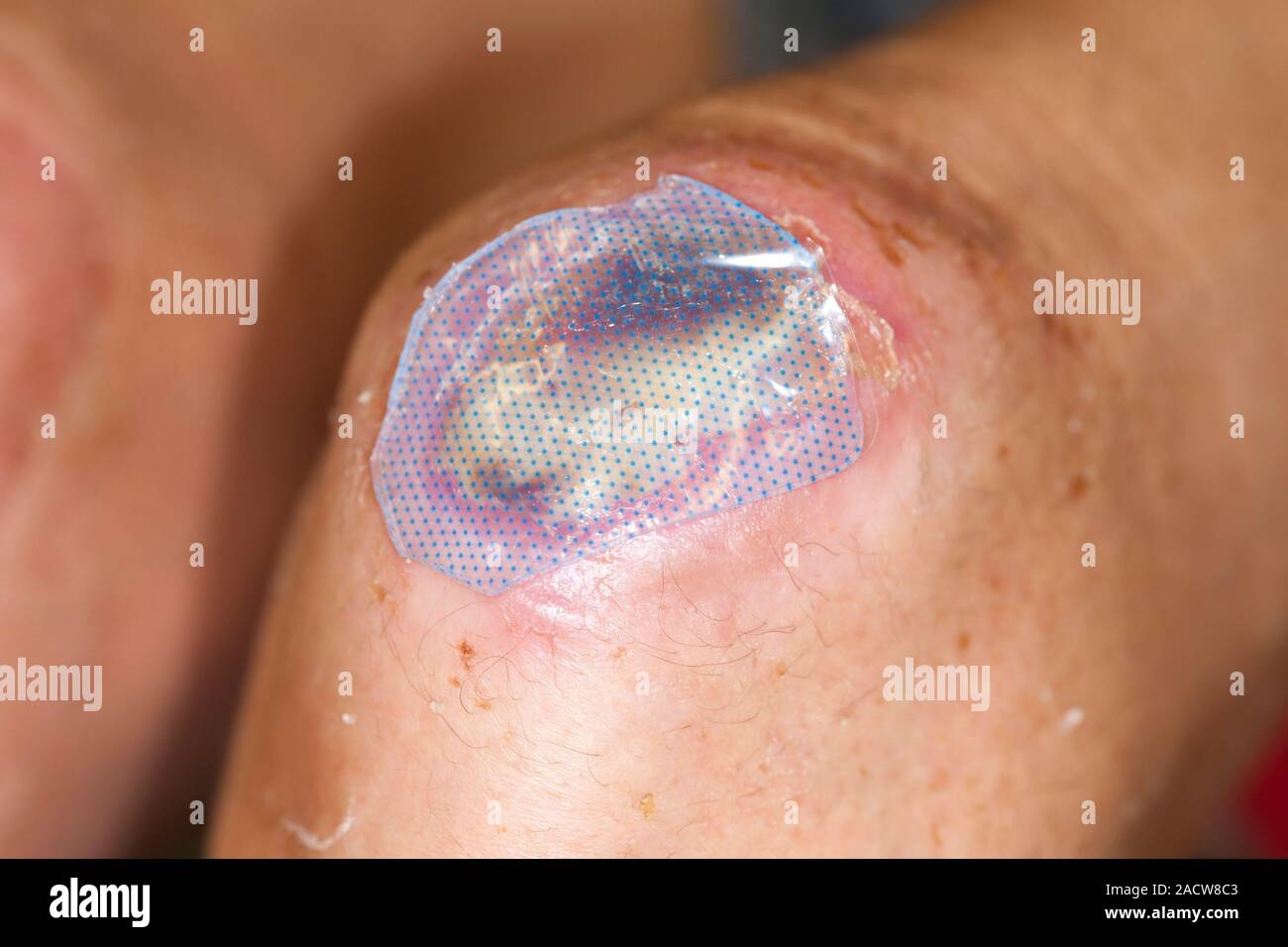Genoux infectés ulcère. Close-up d'un pansement sur une plaie infectée sur  le genou d'un 42-year-old female patient diabétique. Cette forme d'ulcère  d'une infe Photo Stock - Alamy