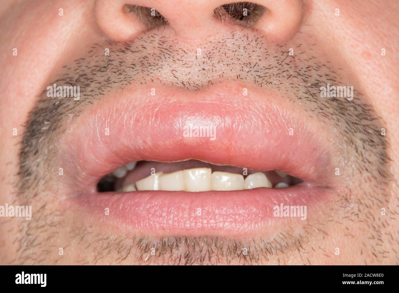 Lèvres enflées. Close-up de la lèvre gonflée d'un 42-year-old male patient  causé par l'œdème de Quincke (œdème angioneurotique). L'œdème de Quincke  est une réaction allergique Photo Stock - Alamy