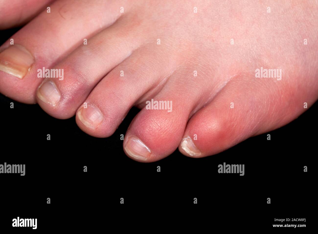 Engelures aux doigts. Close-up d'engelures aux doigts d'une jeune femme de 16 ans patient. Engelures (perniosis) sont les démangeaisons causées par gonflement rouge e Banque D'Images