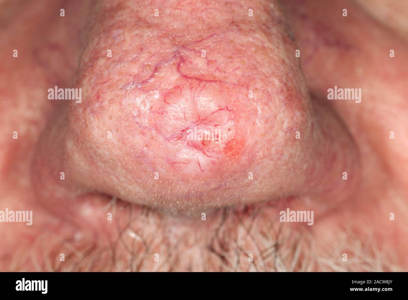 Cancer De La Peau Sur Le Nez Photo Cancer de la peau. Close-up d'un carcinome baso-cellulaire (CCC) sur le nez  d'un 68-year-old male patient. BCC est la forme la plus courante de cancer  de la peau causé par Photo Stock -