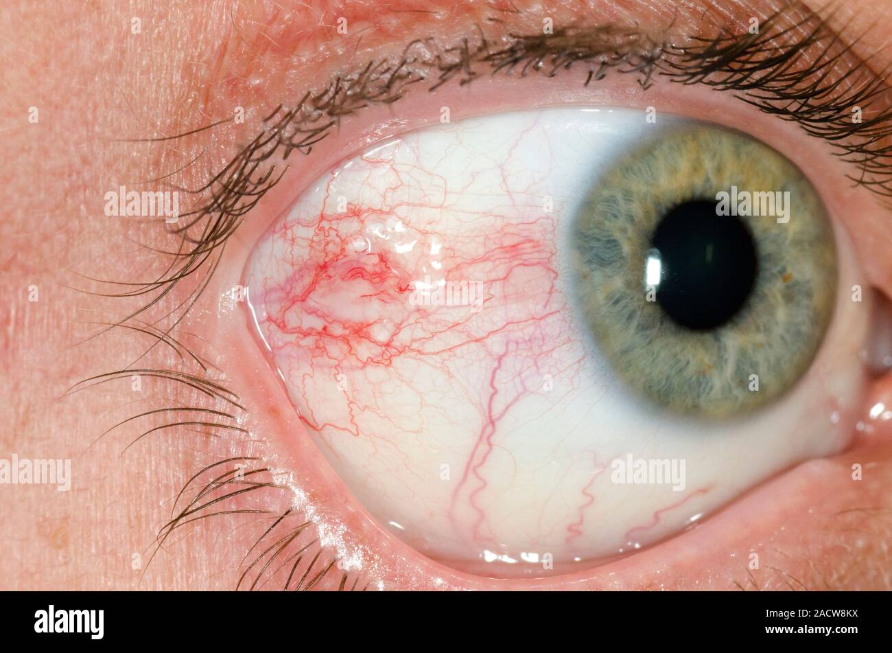 L'oeil rayé. Close-up de l'oeil d'un homme de 41 ans patient qui était griffé par un chat. Banque D'Images