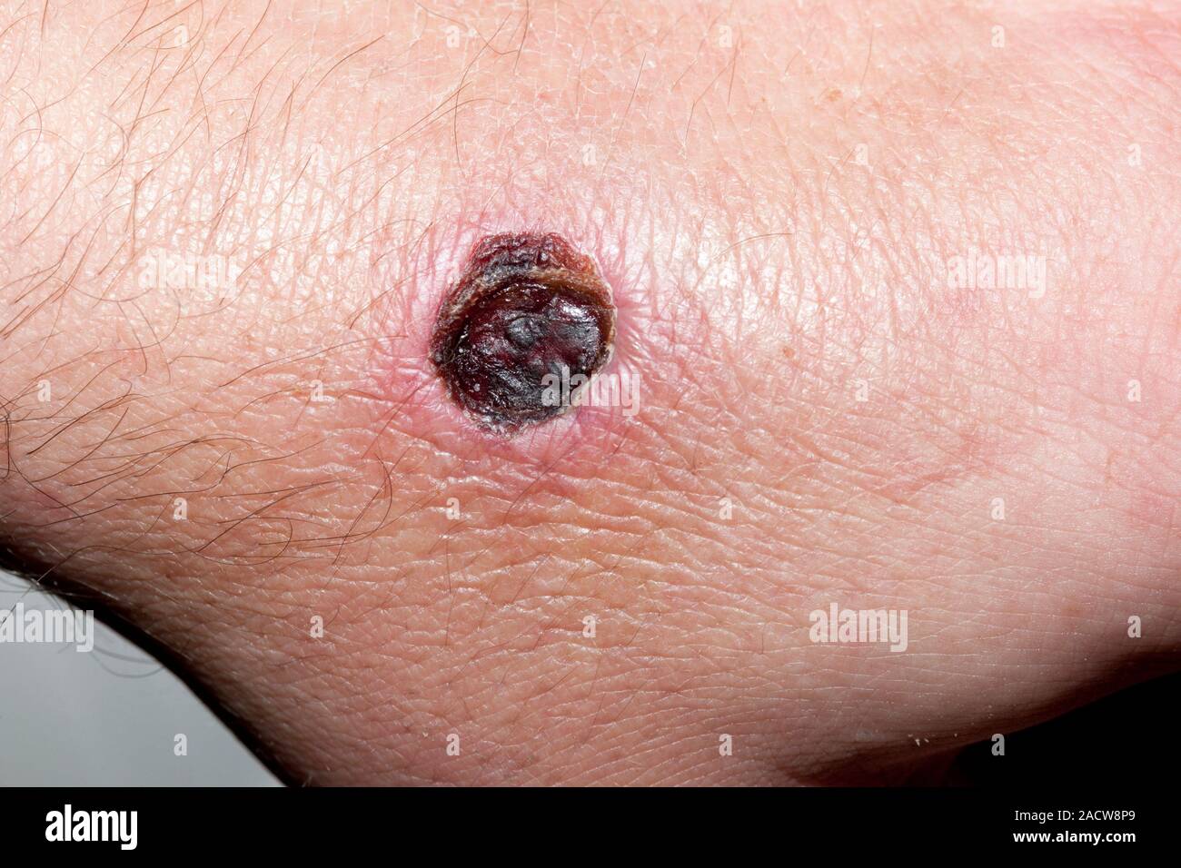 Morsure d'araignée. Close-up d'une blessure à un homme de 41 ans, à la suite des brevets de drainage d'un abcès à l'emplacement d'une morsure d'araignée veuve noire. Ce i Banque D'Images