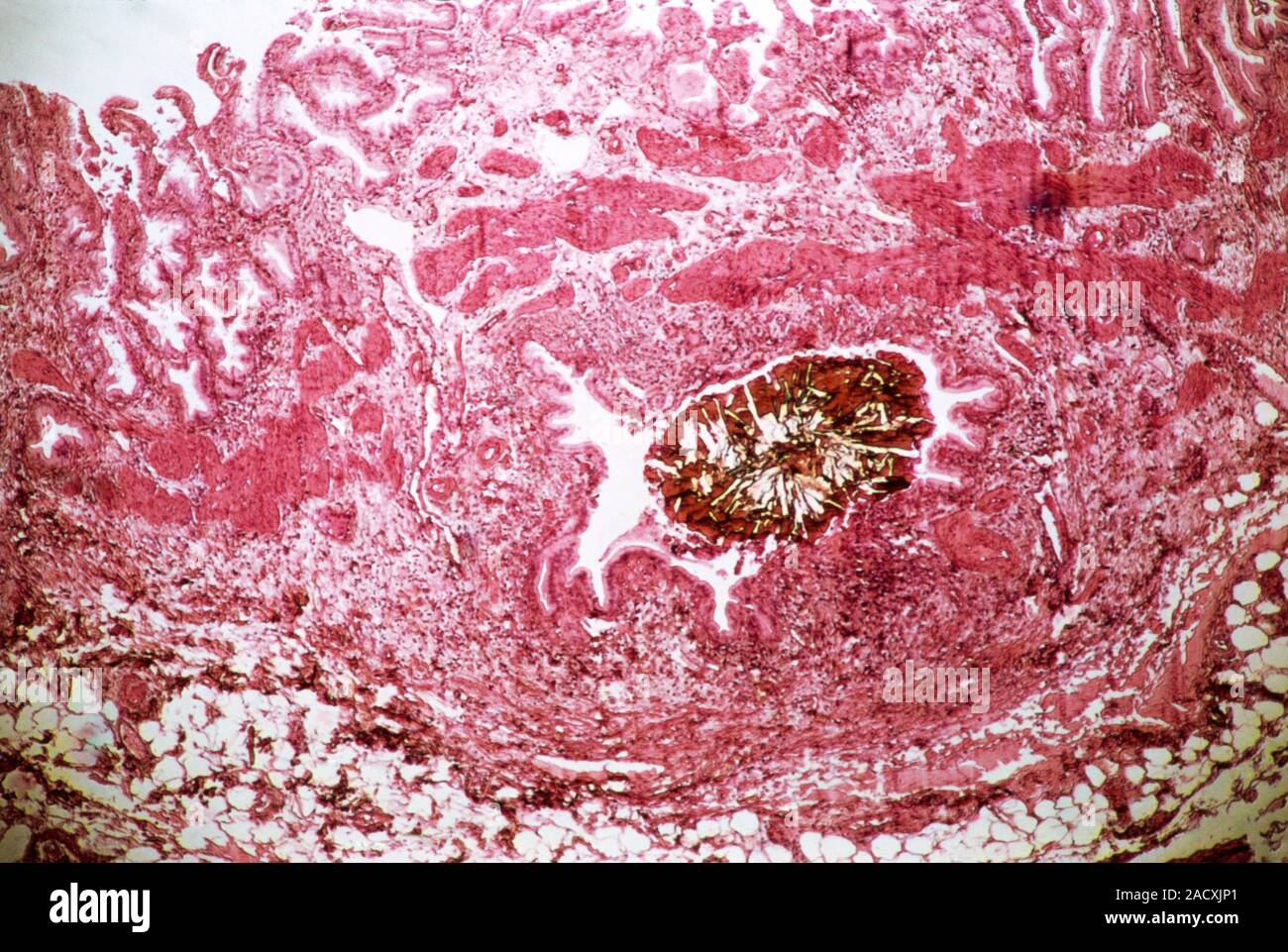 Calculs biliaires. Microphotographie lumière d'une section à travers les tissus de la vésicule biliaire, montrant une lithiase biliaire (Brown, centre droit). La vésicule biliaire stocke la bile, Banque D'Images