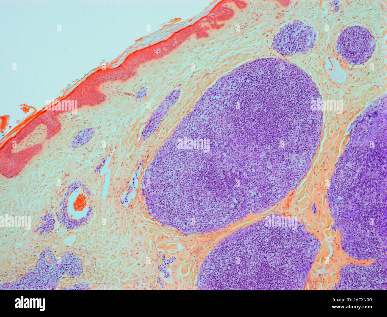 Le lymphome. La lumière microphotographie (LM) de lymphome non hodgkinien ( LNH folliculaire) dans la peau de la poitrine. Le lymphome folliculaire  (violet) est un type commun o Photo Stock - Alamy