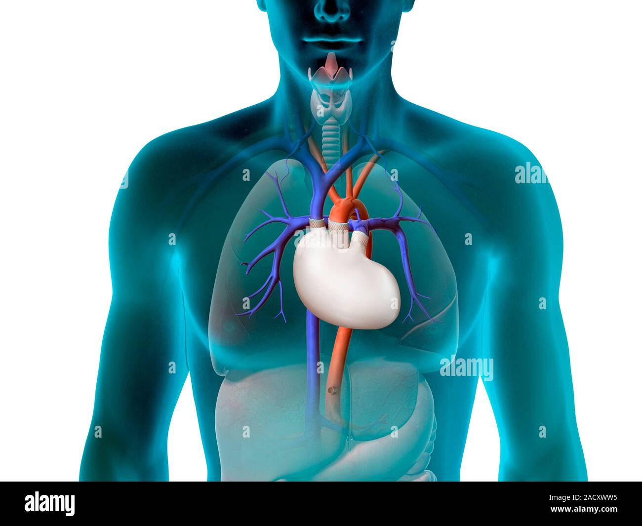 Cœur artificiel. Artwork montrant un cœur artificiel (blanc, centre) implanté dans un thorax du patient. Le cœur artificiel est connecté à l'e Banque D'Images