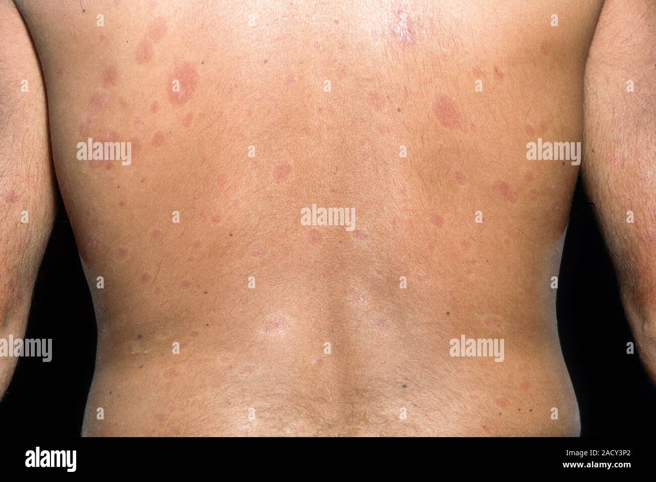 Les plaques de peau épaissie sur le dos d'un patient atteint de