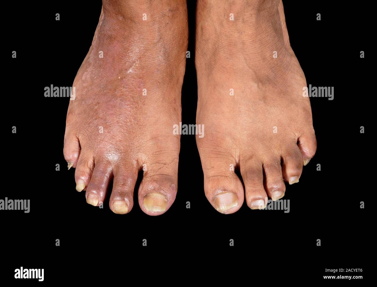 Rhumatisme psoriasique sur un des pieds du patient. L'arthrite psoriasique se produit dans une petite minorité de patients atteints de psoriasis, une maladie de peau chronique je Banque D'Images