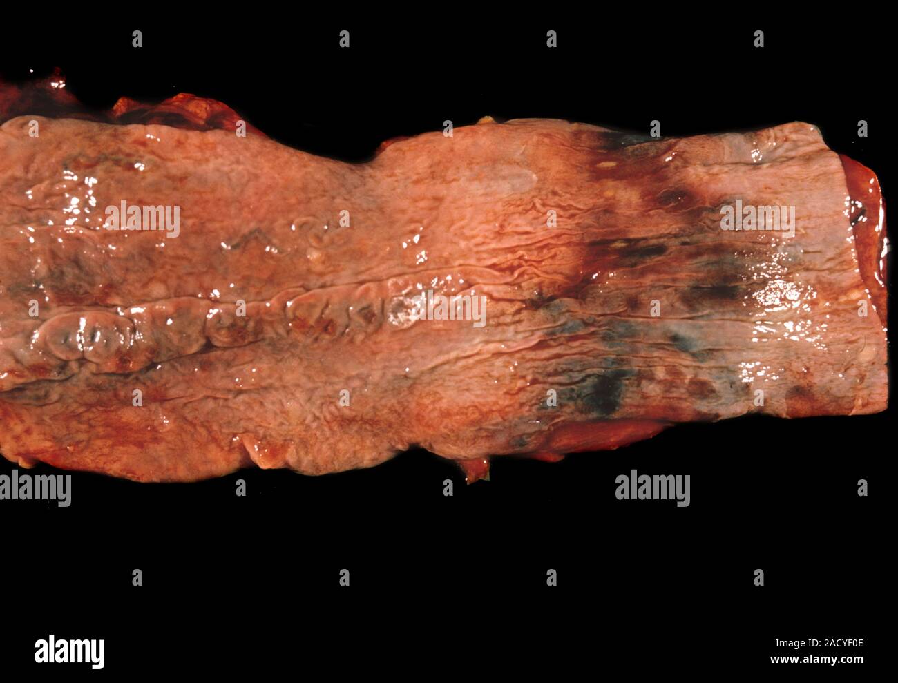 Varices oesophagiennes. Œsophage touchés par les varices (dilatation