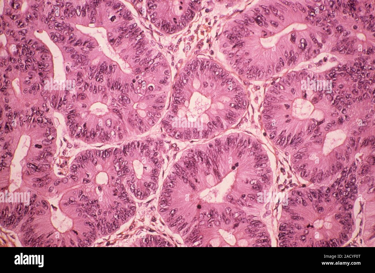 Polype intestinal cancéreuses. Microphotographie lumière d'une section à travers une tumeur cancéreuse (maligne) polype dans le rectum. Les polypes sont généralement bénigne (non-cancerou Banque D'Images