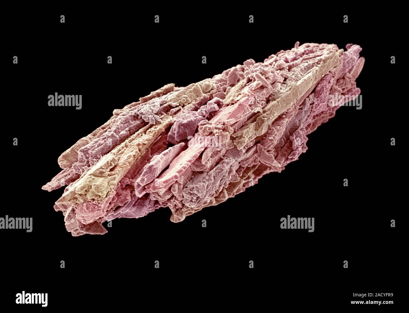 La pierre de rein. Couleur de l'analyse des électrons Microphotographie  (SEM) de la surface d'une pierre de rein. Les calculs rénaux sont  habituellement formées par la précipitation de t Photo Stock -