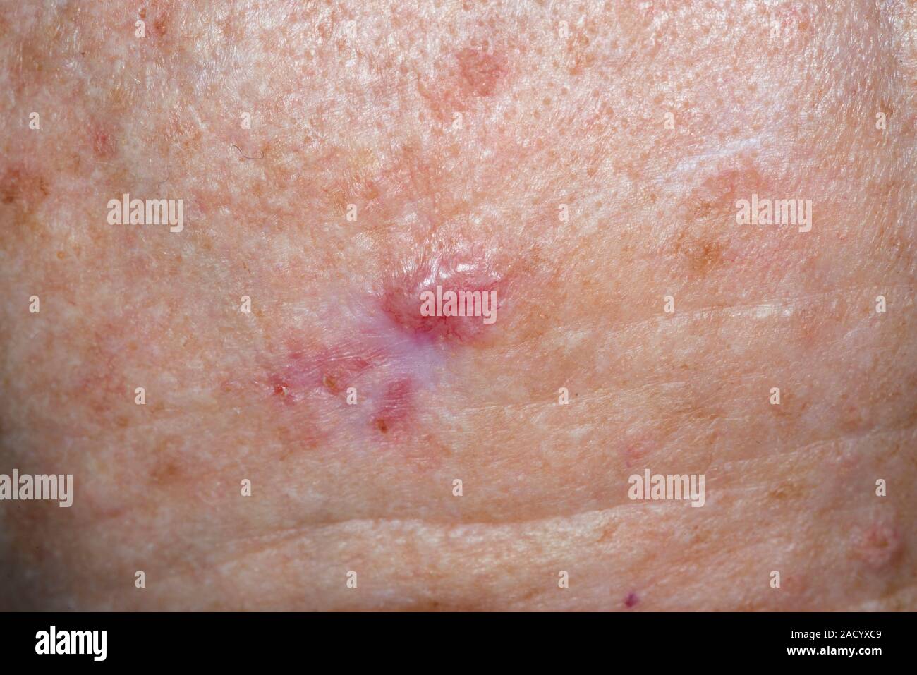 Cancer de la peau. Close-up of a-basal cell carcinoma (cancer de la peau) sur le front d'un 71-year-old male patient. C'est la forme la plus commune de peau annu Banque D'Images