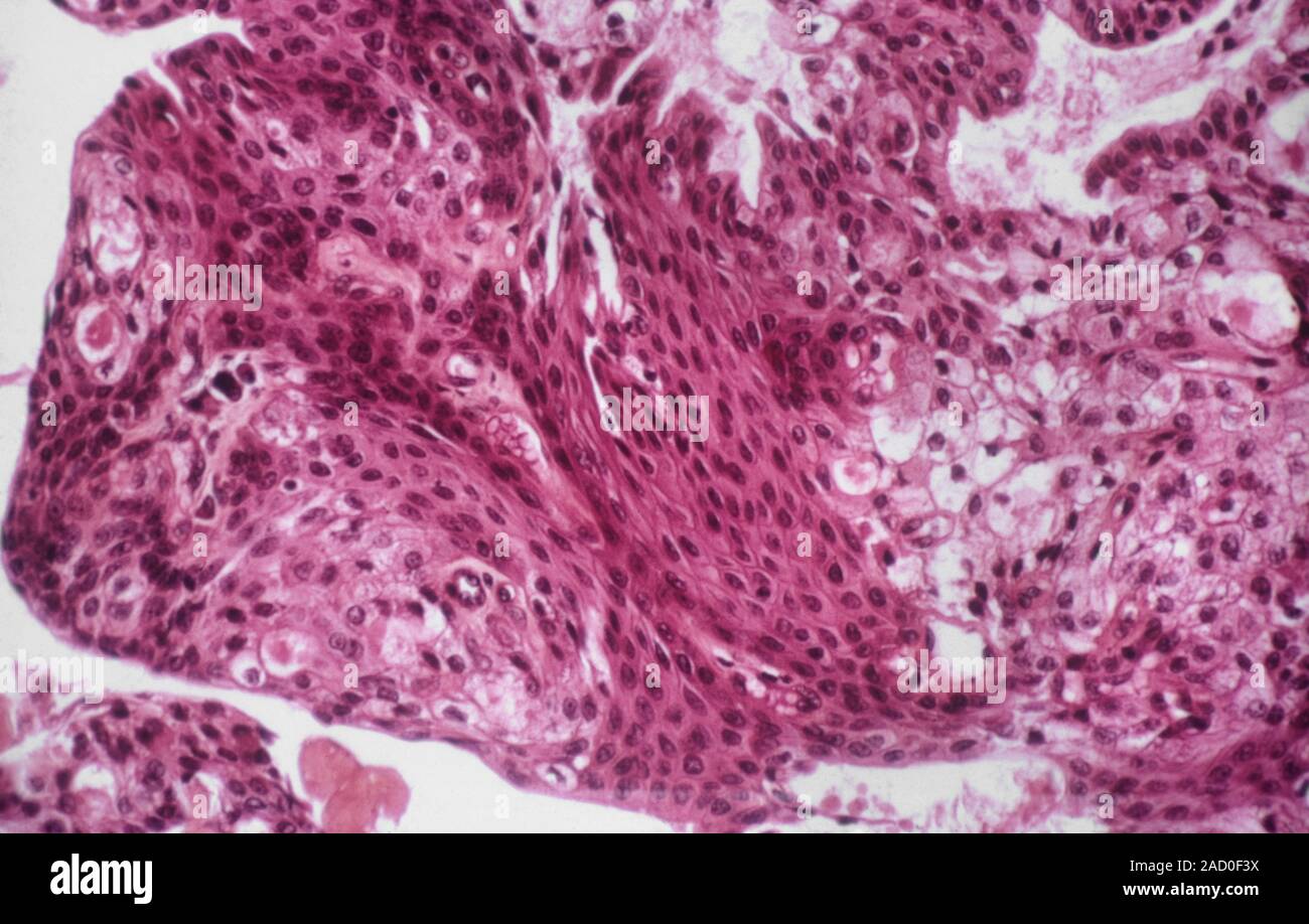 Le cancer des glandes salivaires. Microphotographie lumière d
