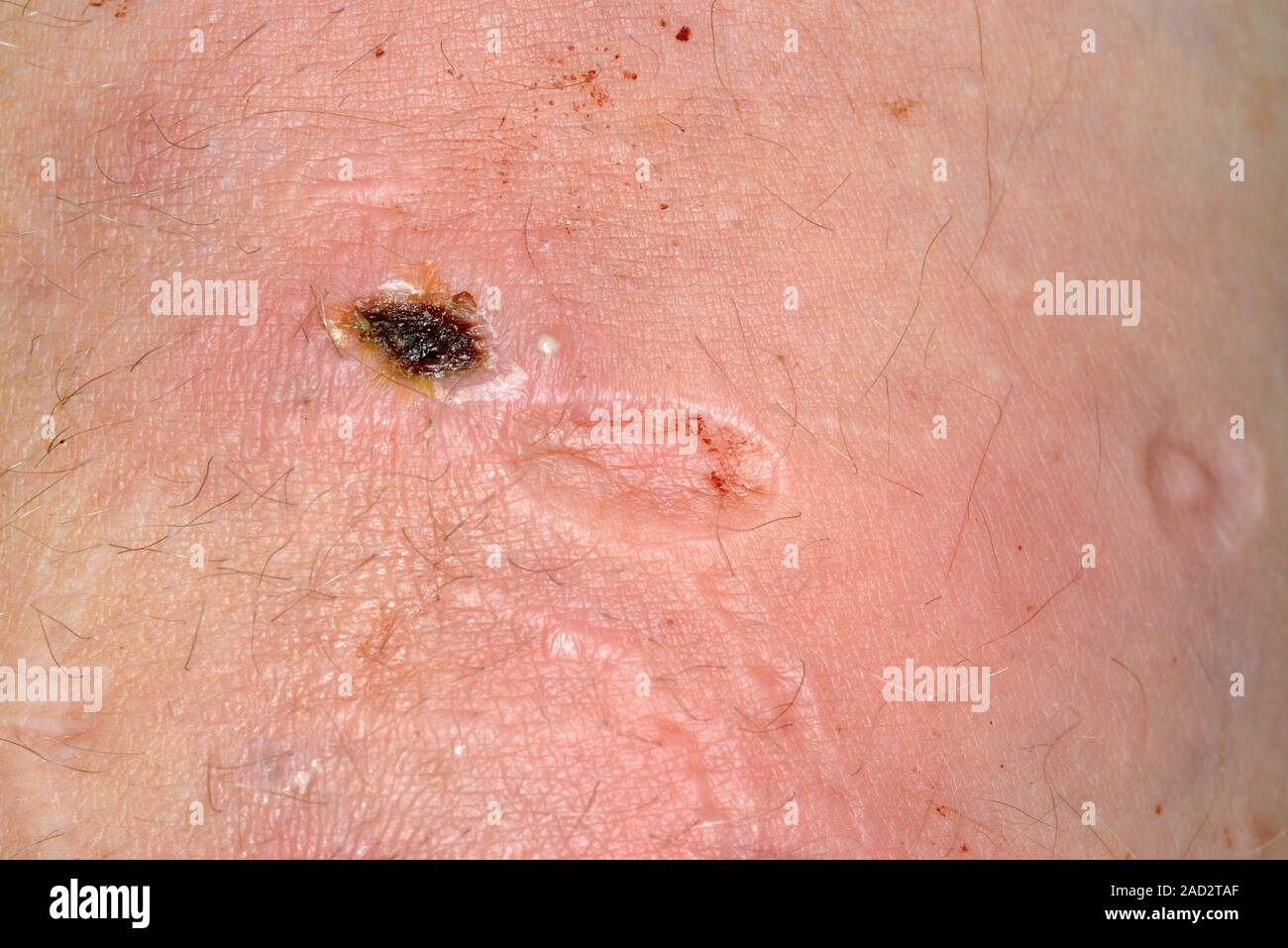 Cicatrices de brûlure de cigarette à l'autodestruction. Close-up de  cicatrices de brûlures de cigarettes sur les bras d'un 36-year-old male  patient ayant des antécédents d'-har Photo Stock - Alamy