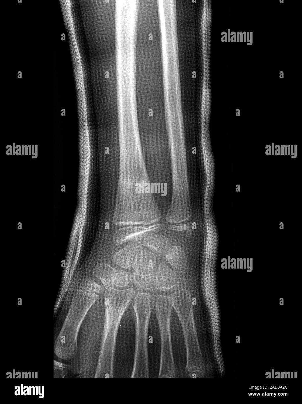 Fracture du Xray d'une section à travers le gauche d