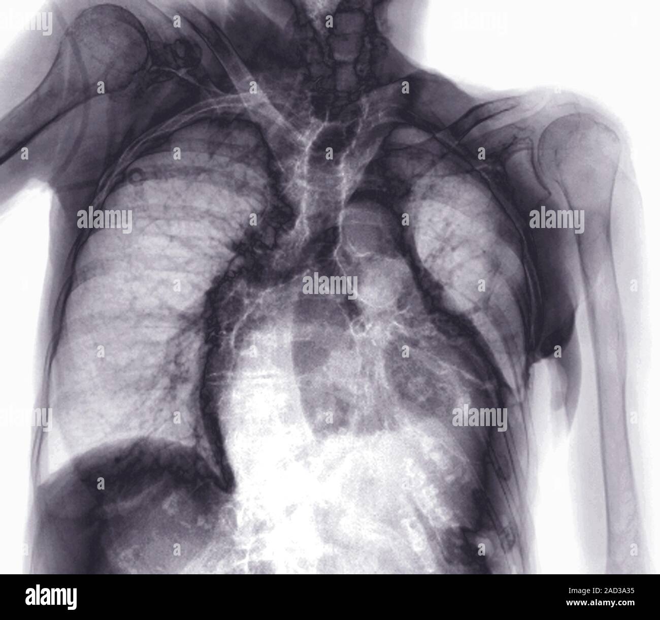 L'épanchement pleural. Radiographie d'un 80-year-old patient sous ...