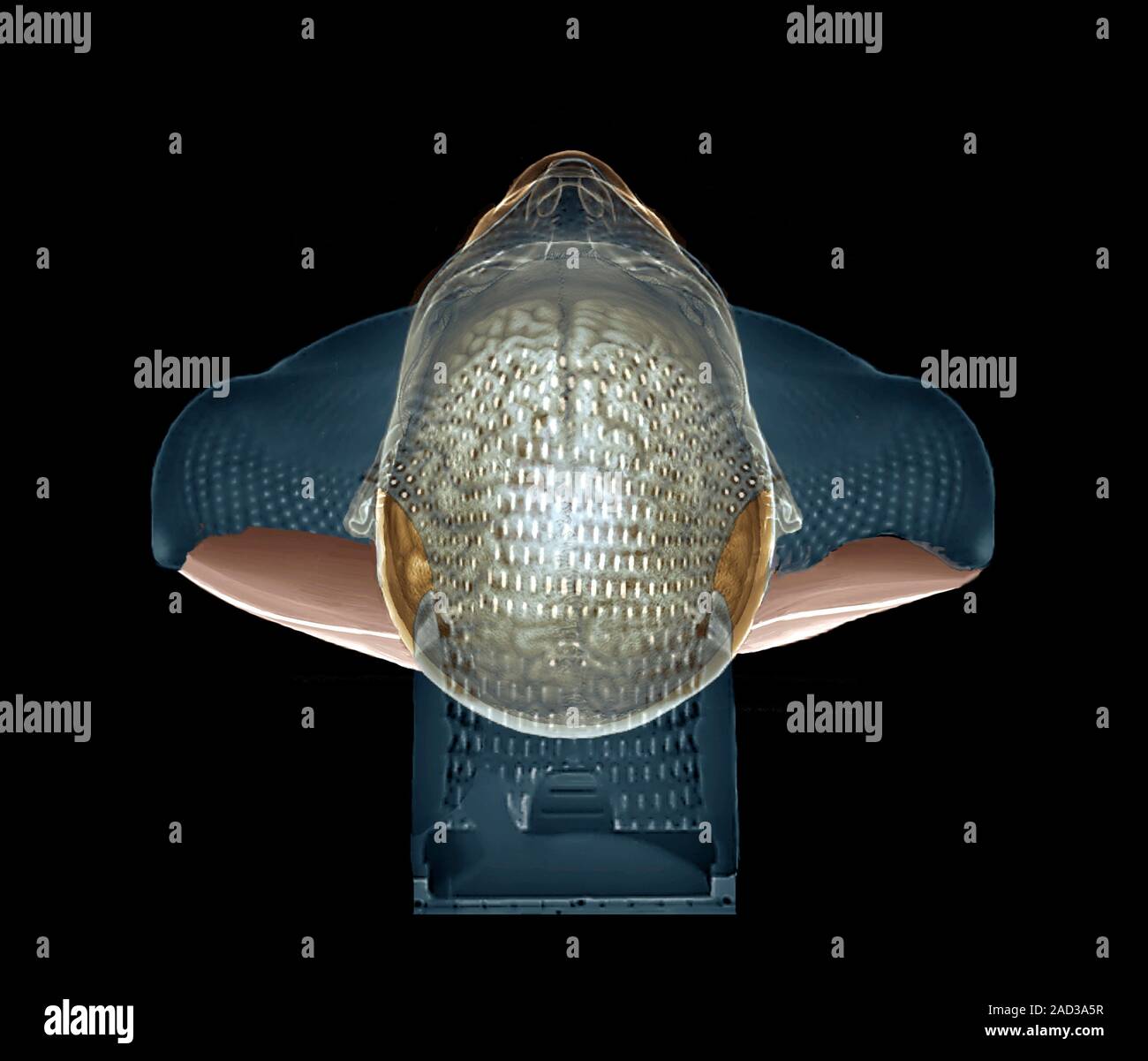 Tumeur au cerveau traitement de radiothérapie. 3D computed tomography — free download