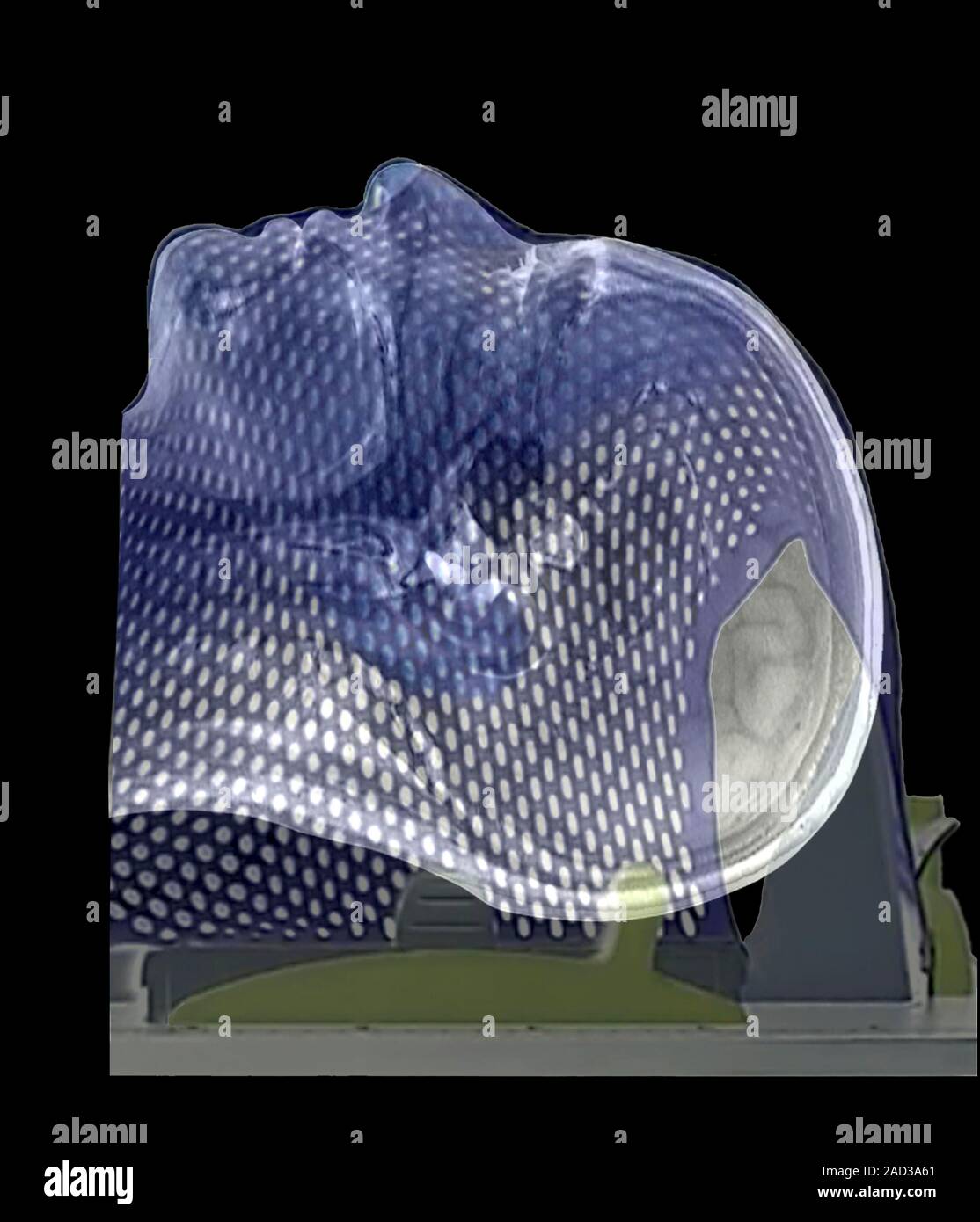 Tumeur au cerveau traitement de radiothérapie. 3D computed tomography — free download