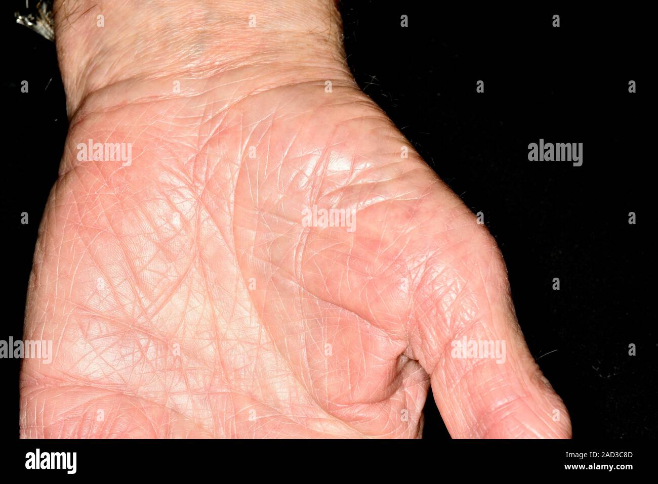 L'atrophie musculaire dans le syndrome du canal carpien. Détail de la