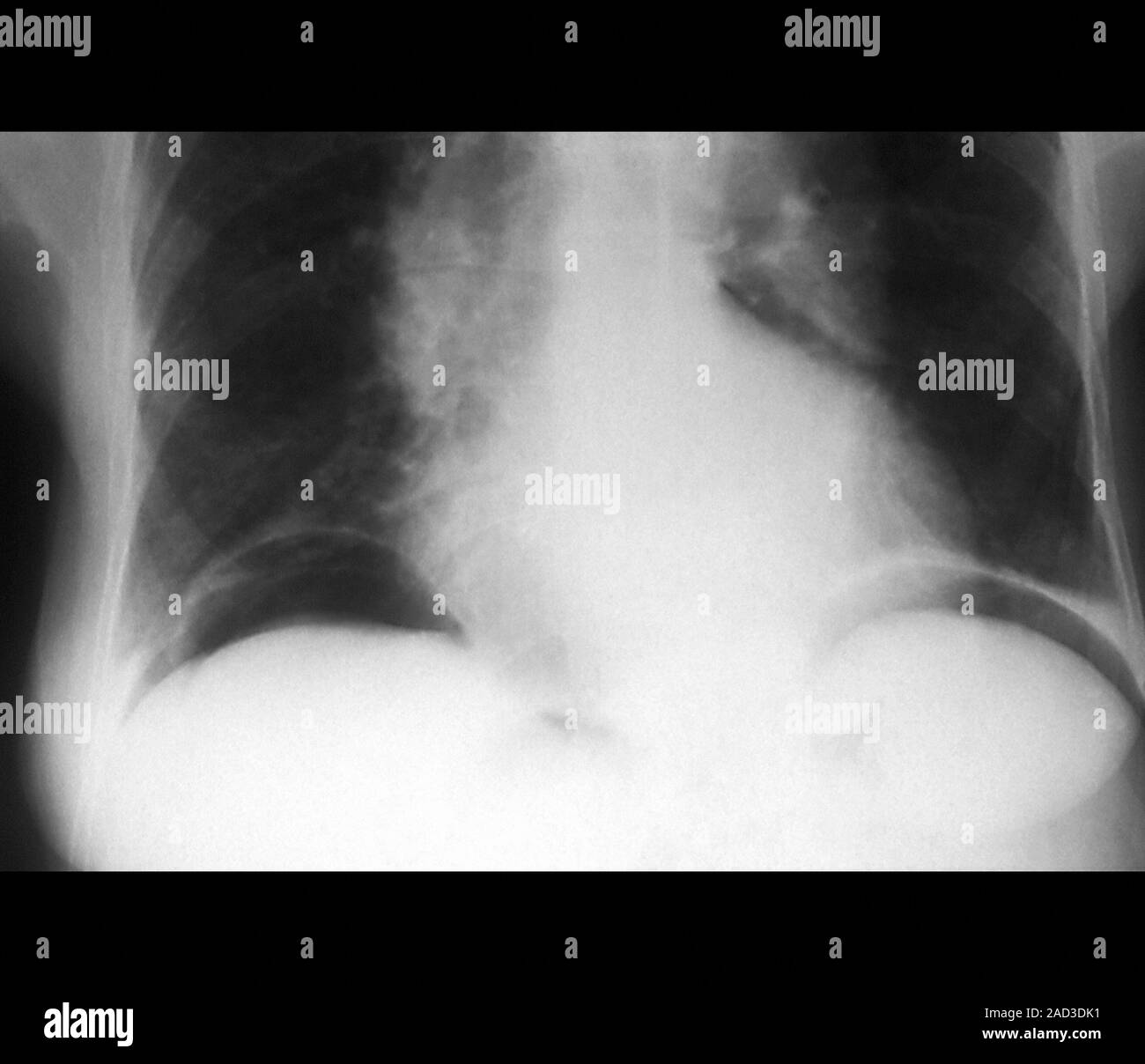 Des poches d'air. Radiographie de la frontale de 62 ans, patient avec l ...