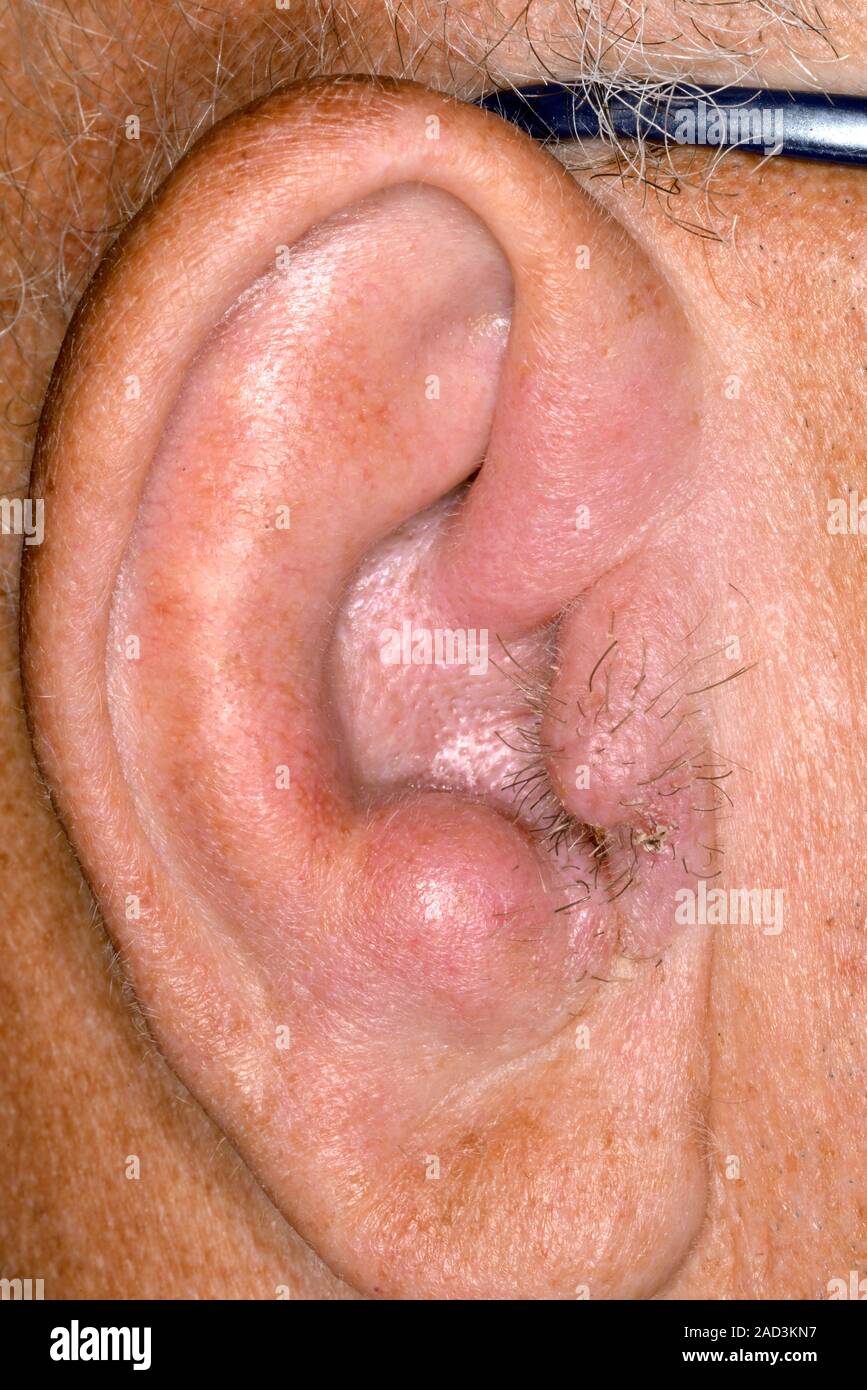 Inflammation de l'oreille. Close-up de la pinna gonflée de l'oreille d'un  57-year-old male patient avec l'otite externe (otite externe, ou l'otite),  et de l'infl Photo Stock - Alamy