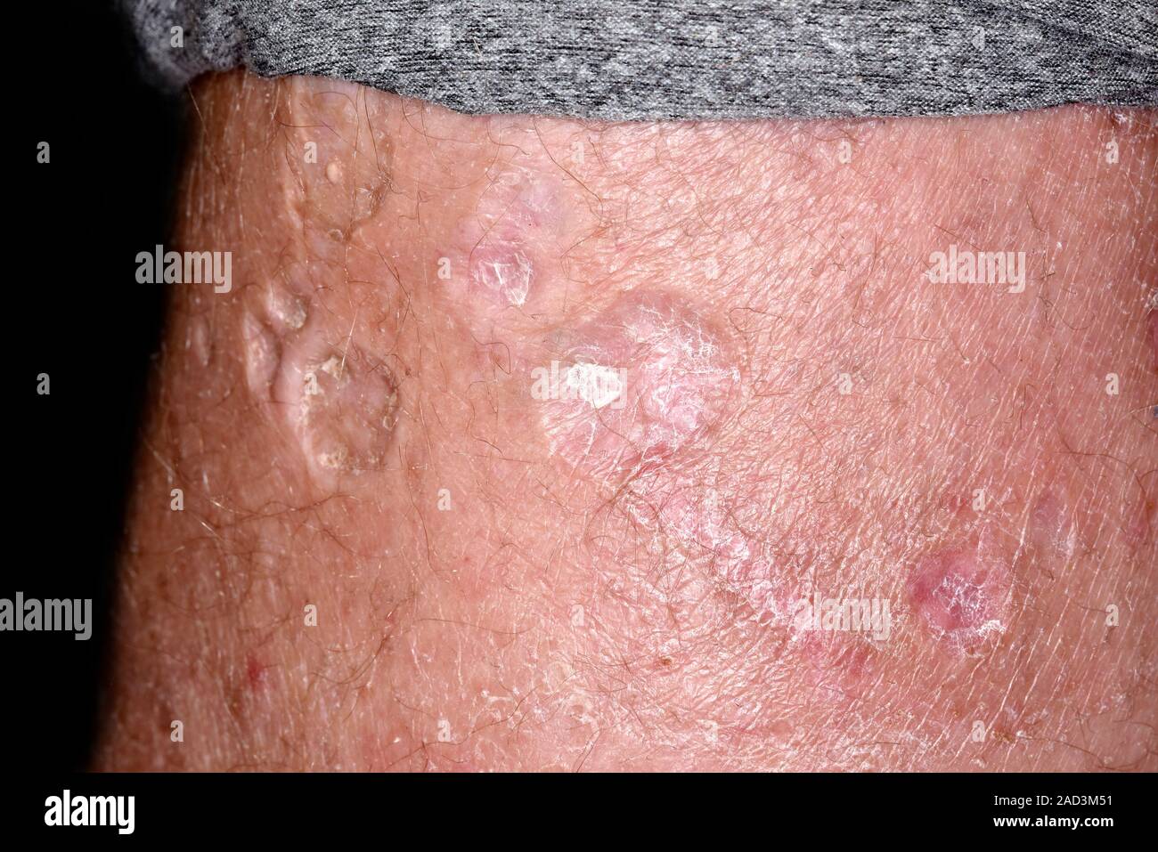 Cicatrices de brlure de cigarette l'autodestruction. Close-up de vieilles cicatrices de brlures de cigarettes sur la peau d'un 36-year-old male patient psychiatrique avec une histoire de Photo Stock - Alamy Cicatrices de brlure de cigarette l'autodestruction. Close-up de vieilles cicatrices de brlures de cigarettes sur la peau d'un 36-year-old male patient psychiatrique avec une histoire de Photo Stock - Alamy